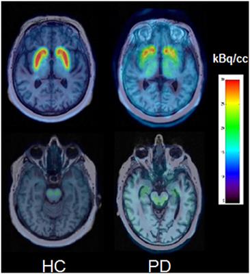 Usefulness of PET With [18F]LBT-999 for the Evaluation of Presynaptic Dopaminergic Neuronal Loss in a Clinical Environment